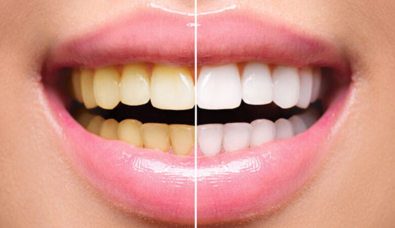 Λεκέδες από δόντια: Όλα όσα πρέπει να γνωρίζετε