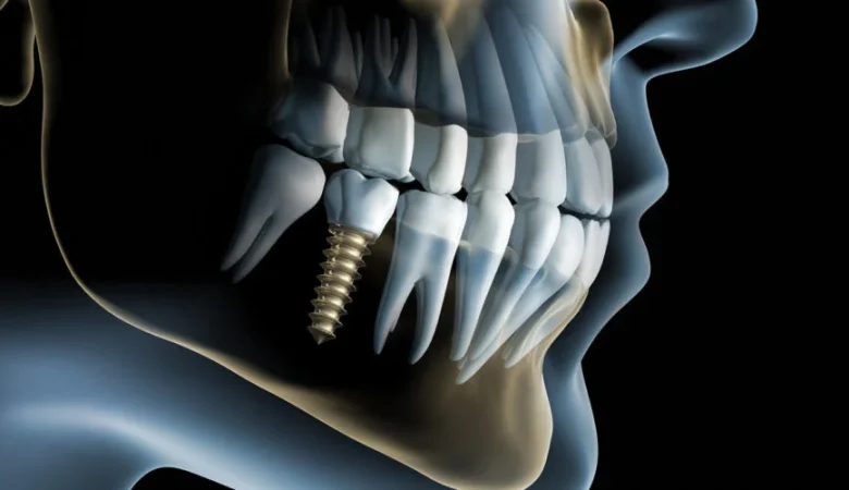 Γιατί είναι τα οδοντικά εμφυτεύματα μια δημοφιλής επιλογή;