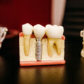Συνήθεις ερωτήσεις σχετικά με τα οδοντικά εμφυτεύματα